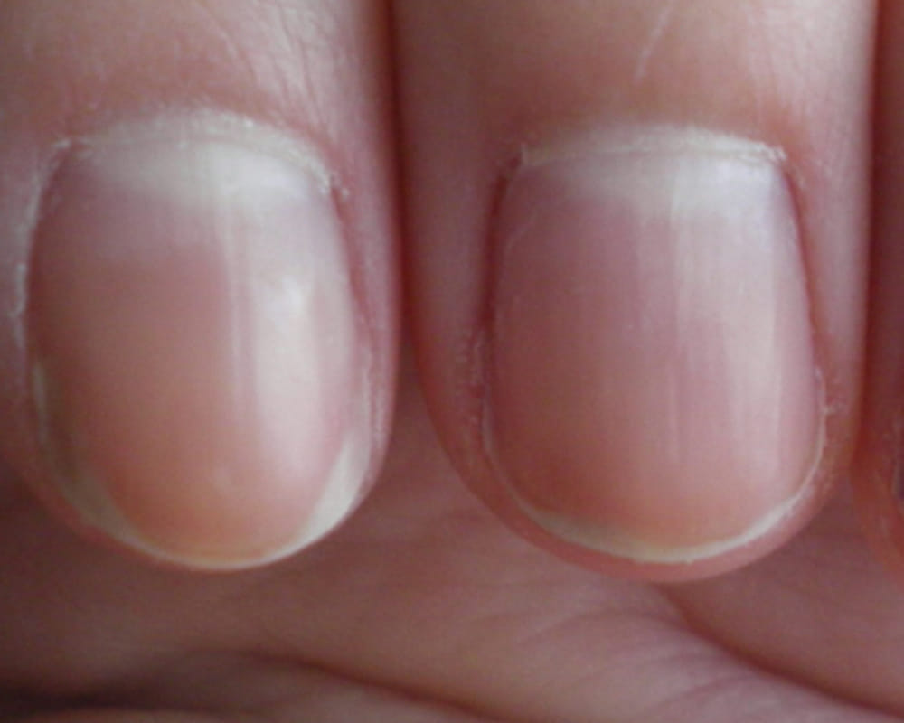 symptoms of iron deficiency