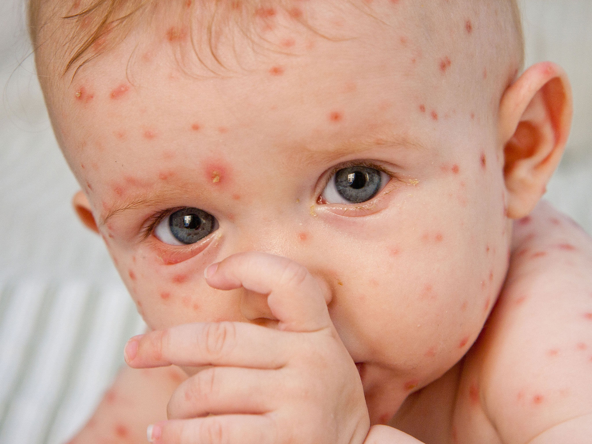 What Is Meaning In Hindi Chicken Pox