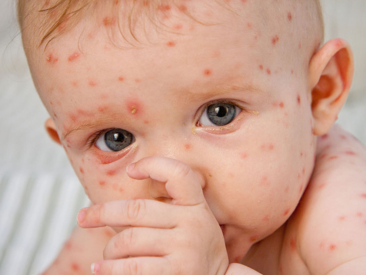 rajasthan: The entire village hit by chickenpox
