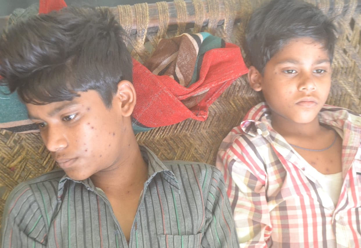 Madhya Pradesh: Government issued advisory for chickenpox after receiving 31 cases in 7 districts
