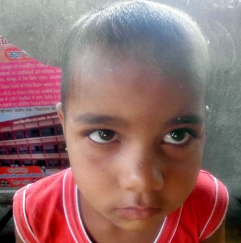 Measles spread over three villages, 25 people ill