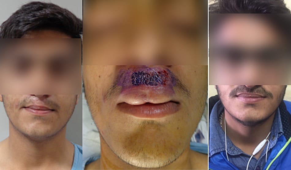 Amazing PGI doctors, after surgery mustaches has grown 