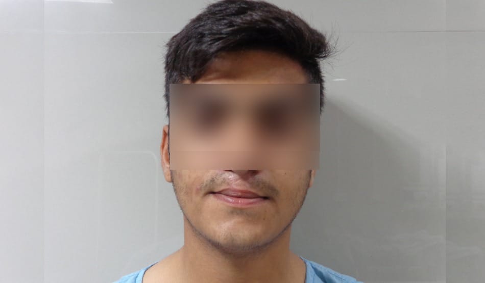 Amazing PGI doctors, after surgery mustaches has grown 