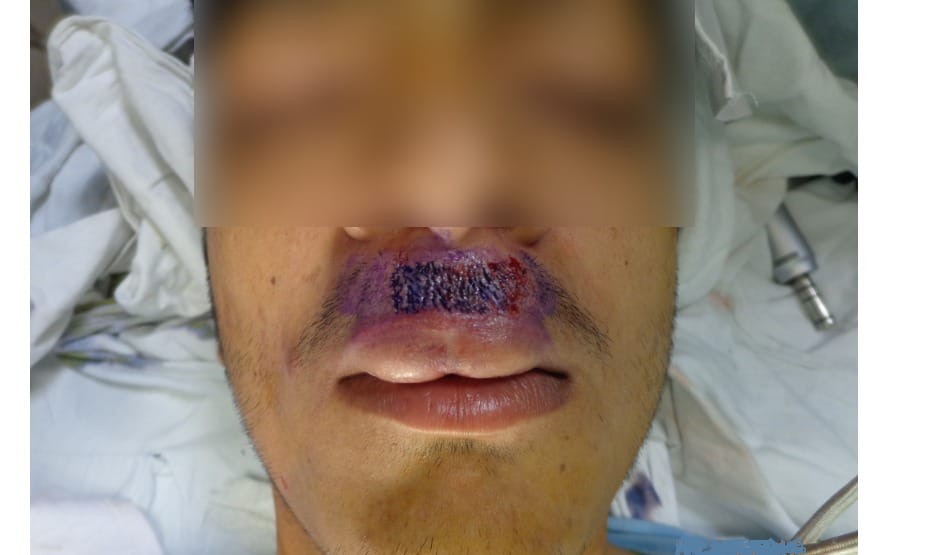 Amazing PGI doctors, after surgery mustaches has grown 