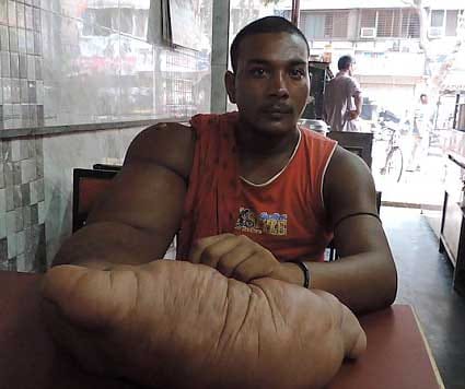 A man with huge 20kg arm 
