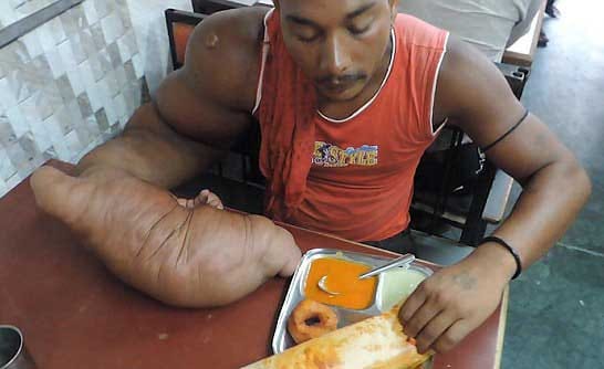 A man with huge 20kg arm 