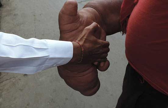 A man with huge 20kg arm 