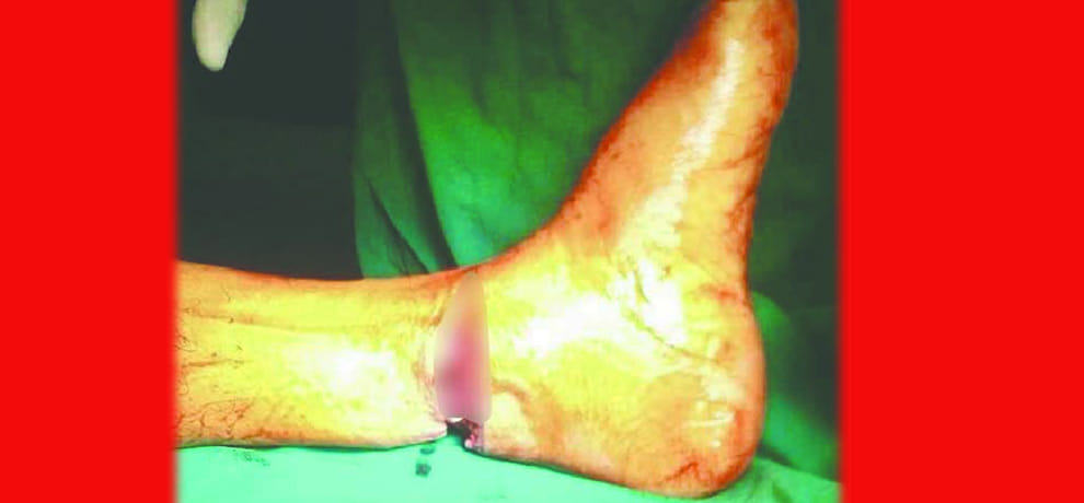 Kite string cut leg badly, for the first time this unique case unfolded