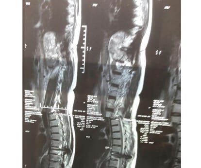  critical surgery in KGMU.