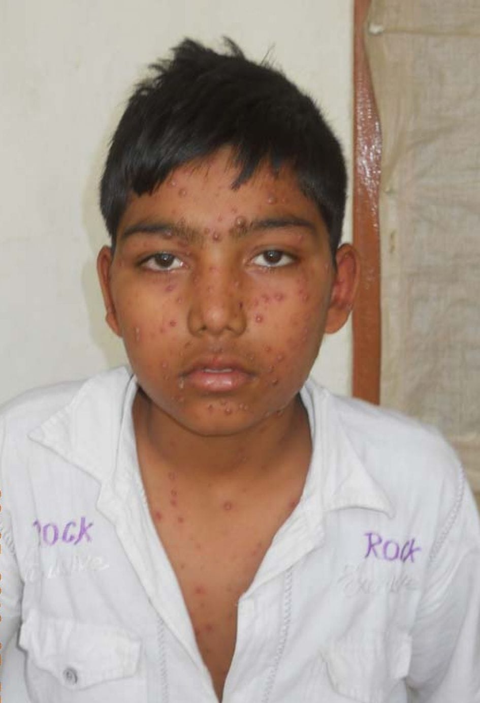 Naurmi two dozen children suffering from chicken pox