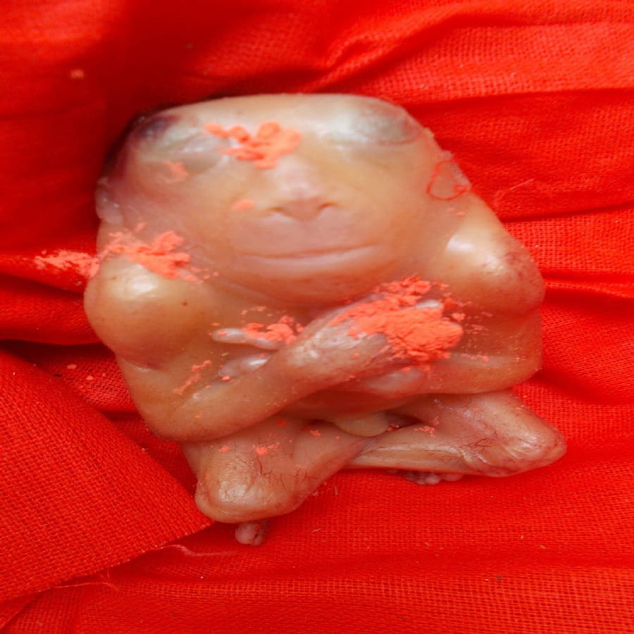 anencephaly kid born in lucknow