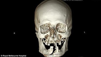Grandfather, 68, who cut his face off with a chainsaw