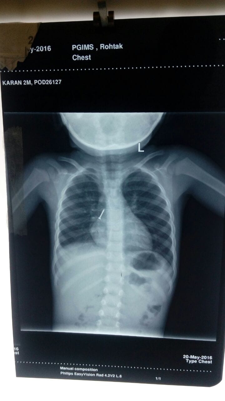 rohtak, health, surgery, chest, pgi, doctor, haryana rohtak
