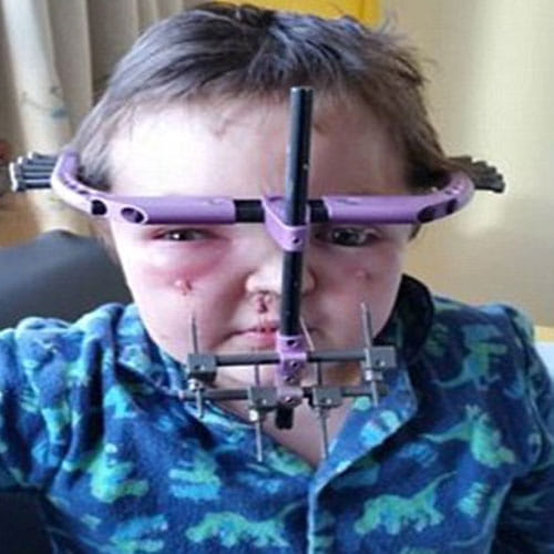 every bone of his face was broken