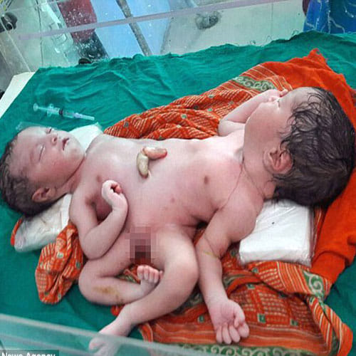 mother gave birth conjoined twins sharing nearly organ