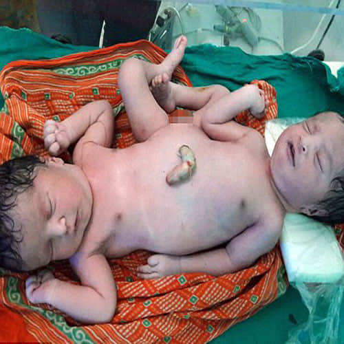 mother gave birth conjoined twins sharing nearly organ