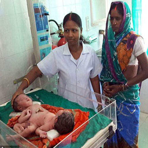 mother gave birth conjoined twins sharing nearly organ