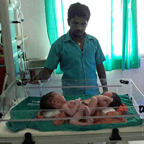 mother gave birth conjoined twins sharing nearly organ