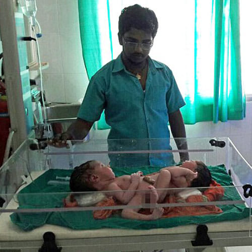 mother gave birth conjoined twins sharing nearly organ