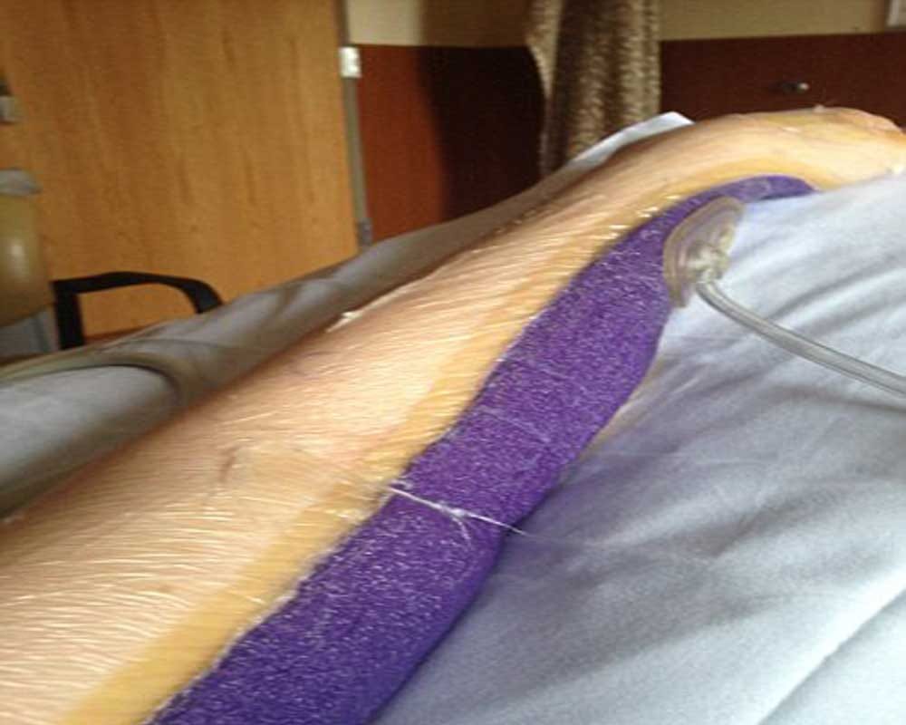 Woman developed a flesh eating bug that ravaged the skin on her left arm  