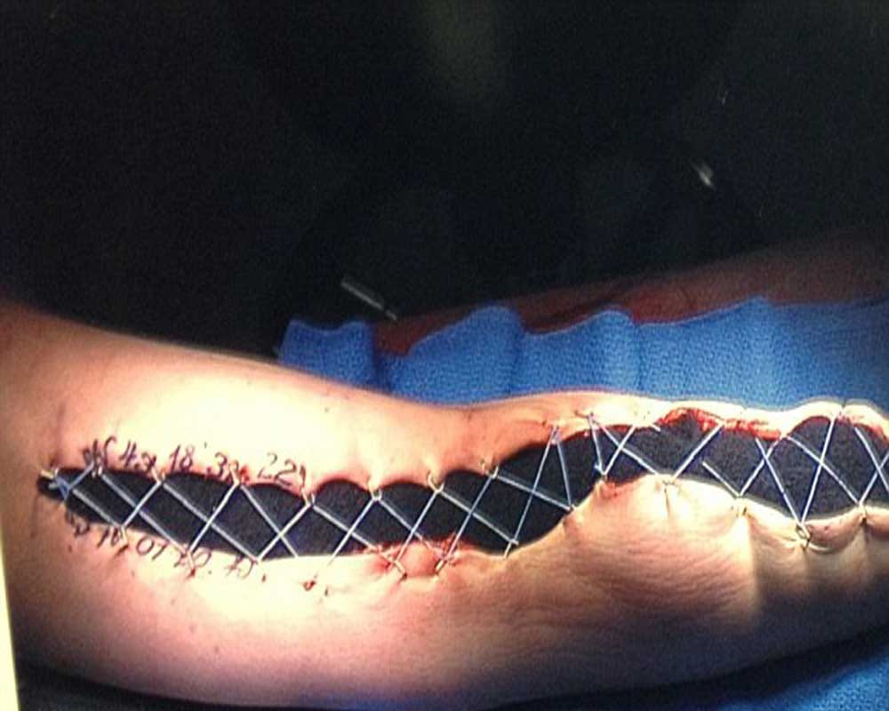 Woman developed a flesh eating bug that ravaged the skin on her left arm  