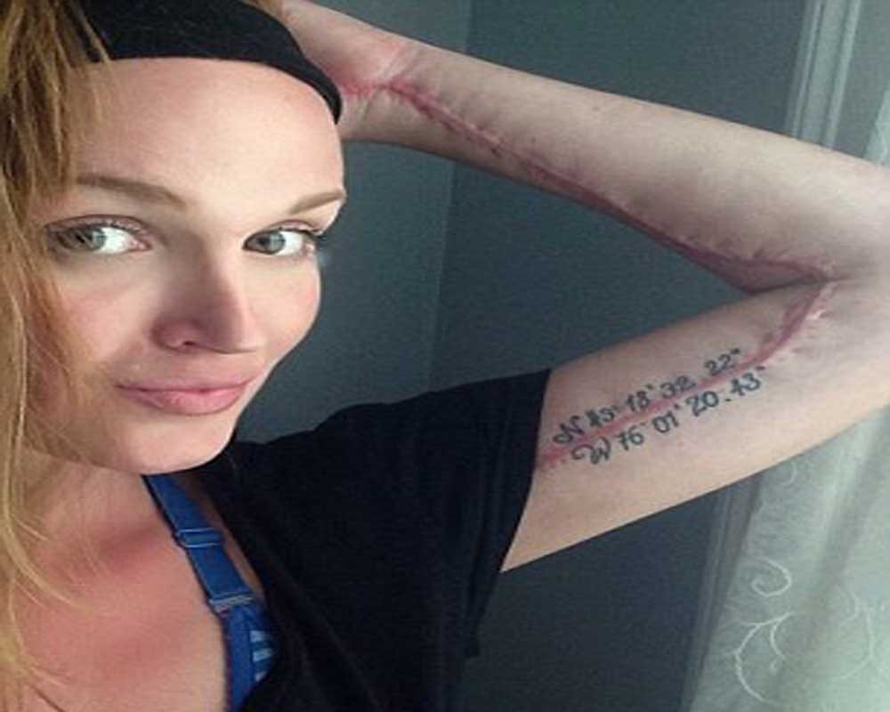 Woman developed a flesh eating bug that ravaged the skin on her left arm  