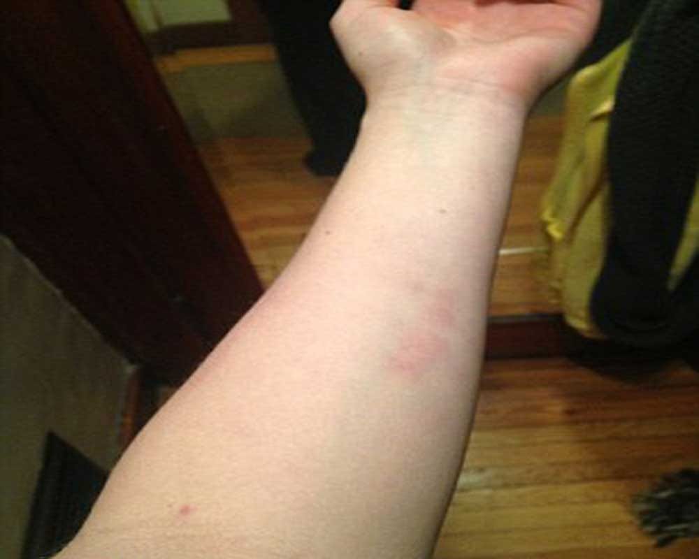 Woman developed a flesh eating bug that ravaged the skin on her left arm  