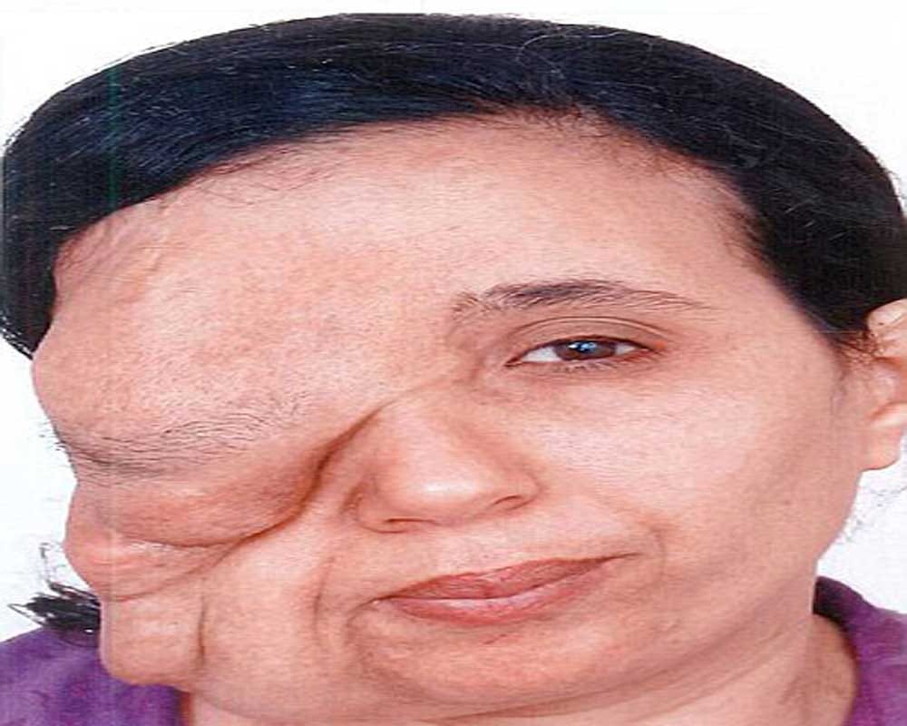 woman suffers from rare genetic condition neurofibromatosis
