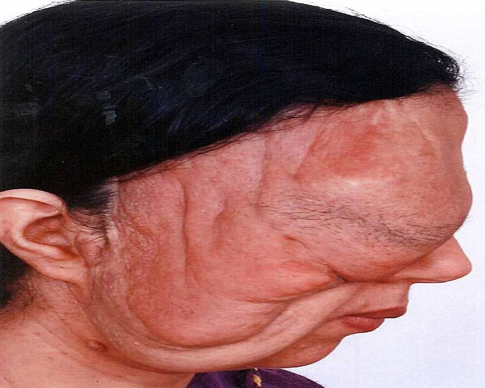 woman suffers from rare genetic condition neurofibromatosis