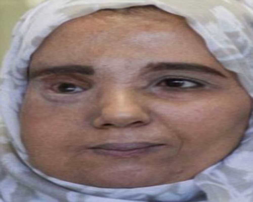 woman suffers from rare genetic condition neurofibromatosis