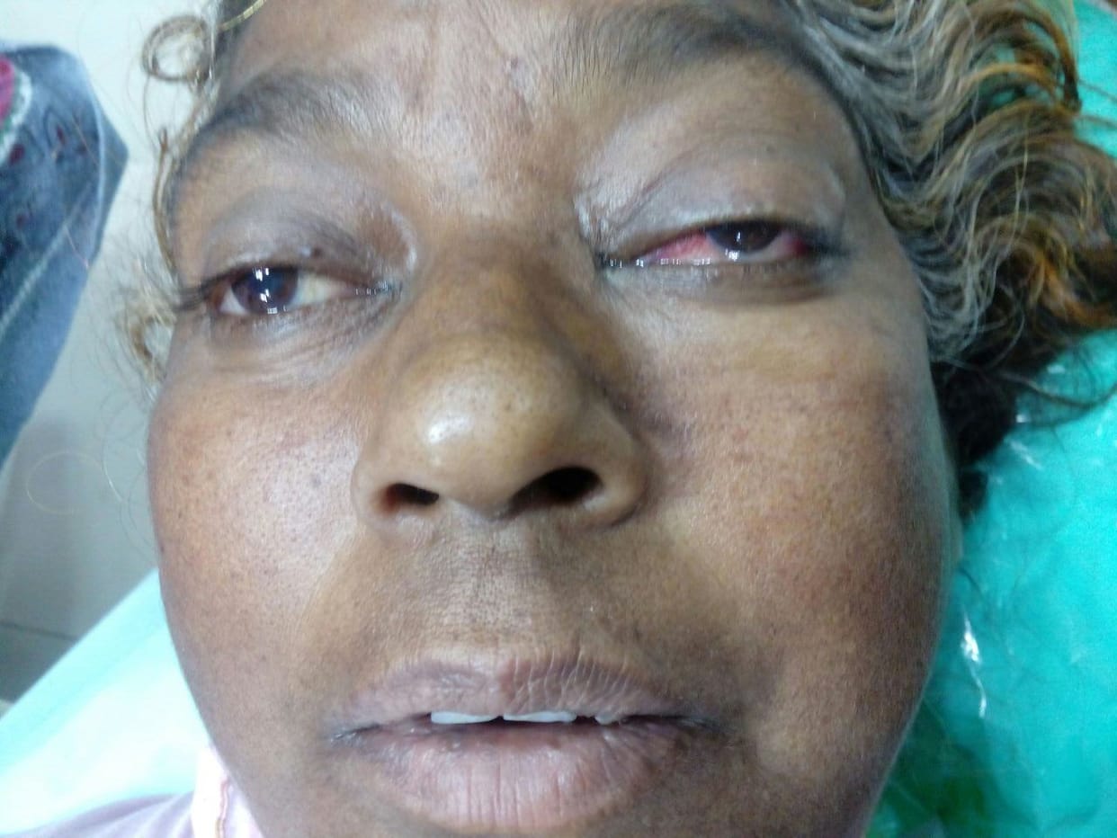lucknow doctor treats carotid cavernous fistula at cheap price
