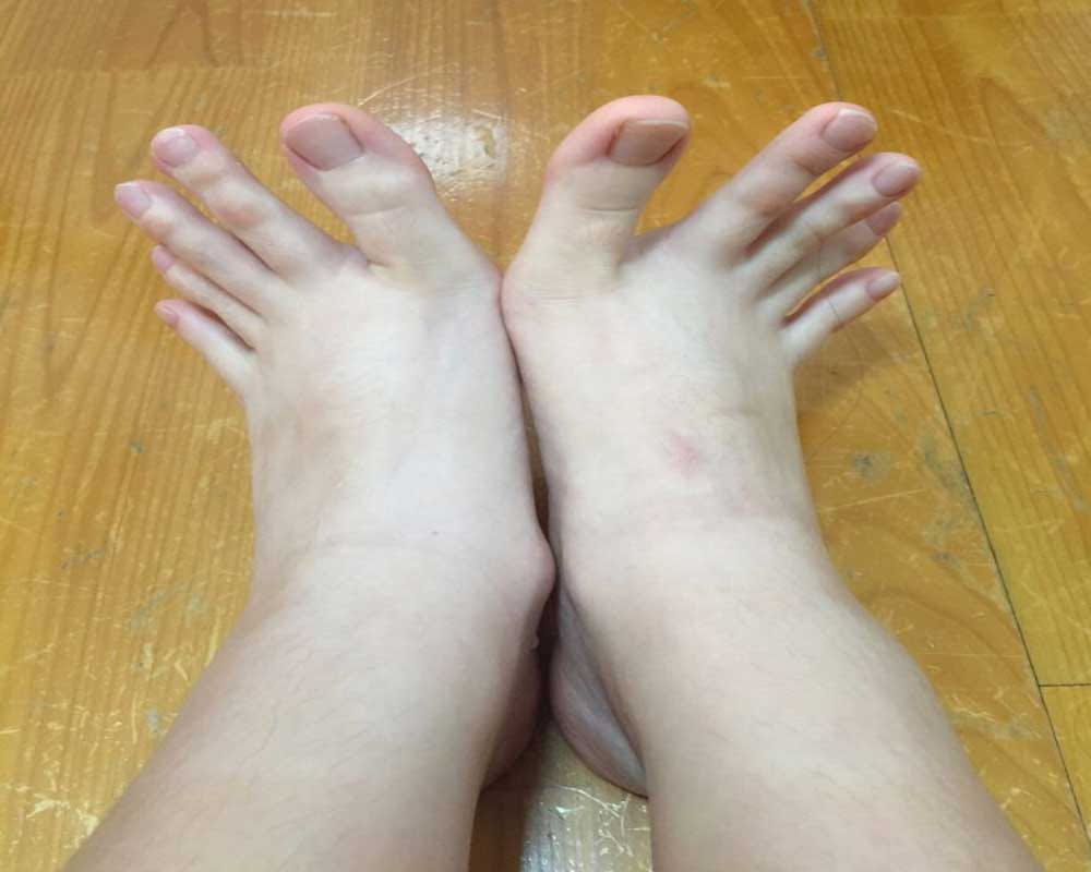 A Taiwanese student  shared pictures of her feet online