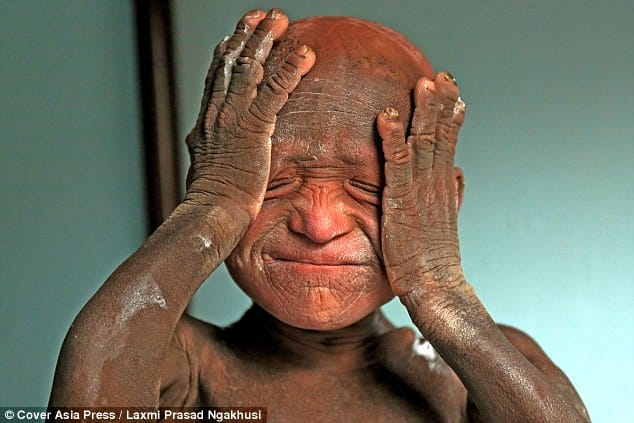 11 year old nepali boy who turning into stone statue 