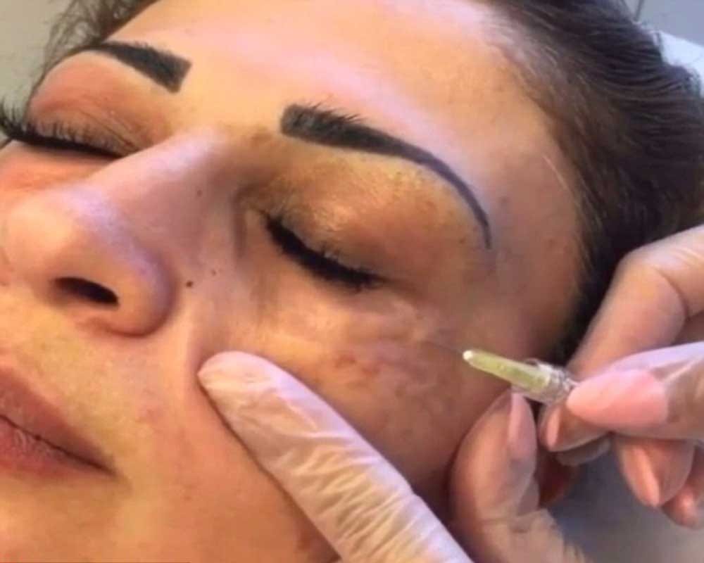 Woman injecting GAS under her eyes to remove to dark circlers 