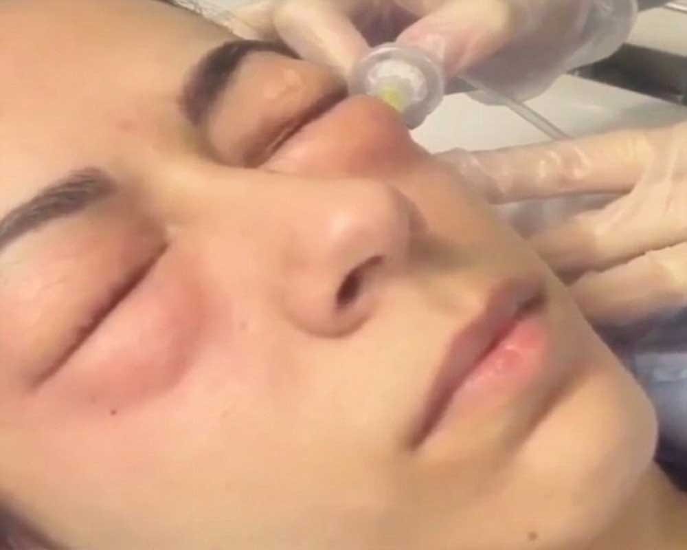 Woman injecting GAS under her eyes to remove to dark circlers 