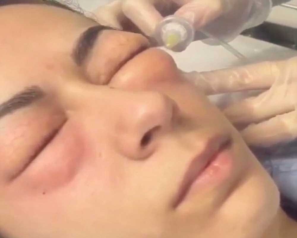 Woman injecting GAS under her eyes to remove to dark circlers 