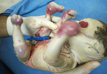 first herlequin babay born in ndia