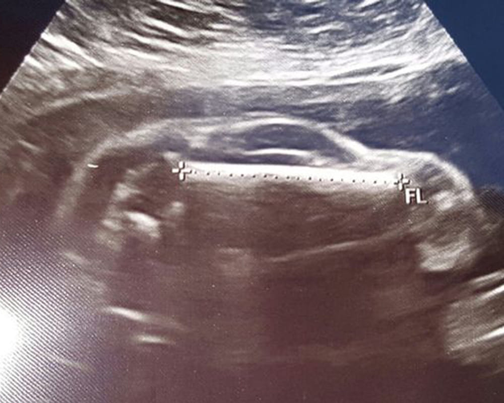 bizarre photo of ultrasound, fetus resembled to car