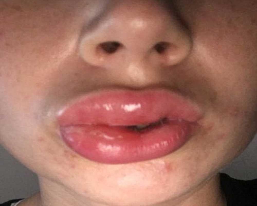 Woman is left with swelling lips after a botched teeth whitening treatment 