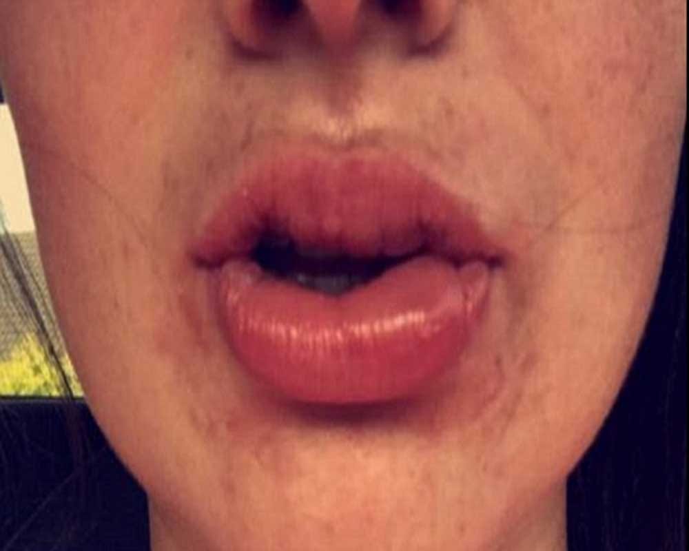 Woman is left with swelling lips after a botched teeth whitening treatment 