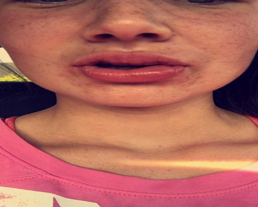 Woman is left with swelling lips after a botched teeth whitening treatment 