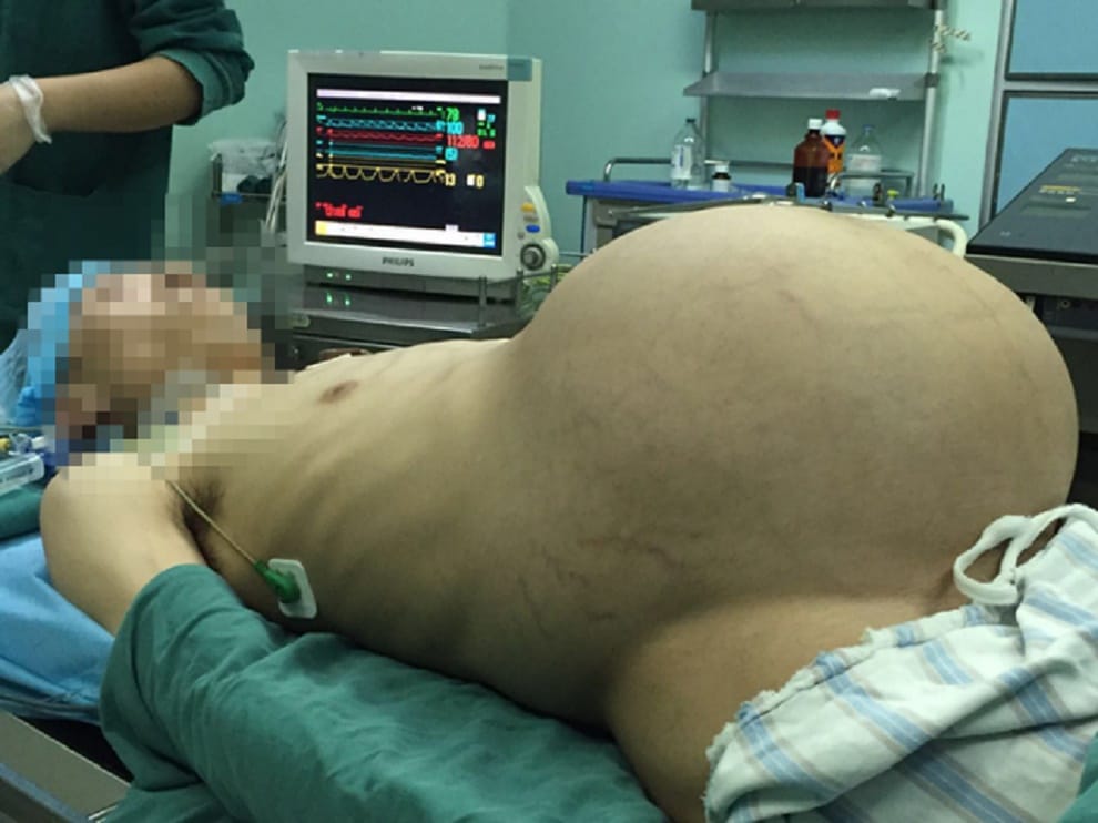 pregnant man had 15 kg tumor