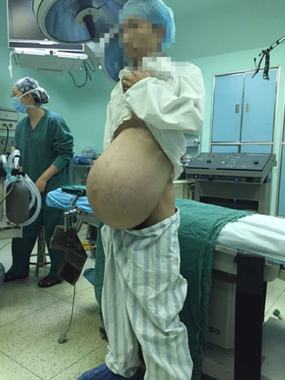 pregnant man had 15 kg tumor