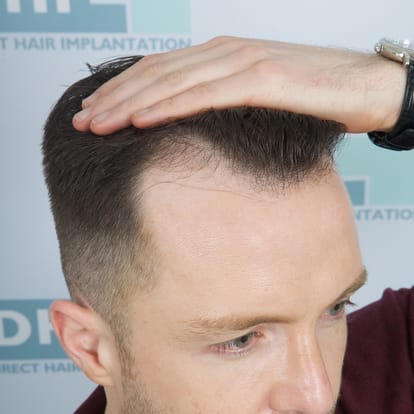 balladness, hair tansplant, hair transplant rules, health news, health tips, chandigarh pgi