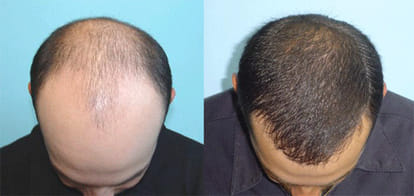 balladness, hair tansplant, hair transplant rules, health news, health tips, chandigarh pgi