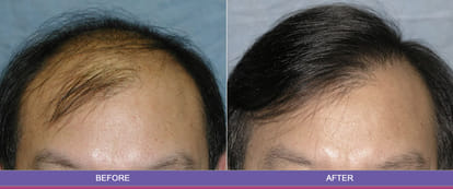 balladness, hair tansplant, hair transplant rules, health news, health tips, chandigarh pgi