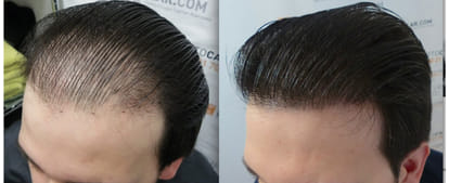 balladness, hair tansplant, hair transplant rules, health news, health tips, chandigarh pgi