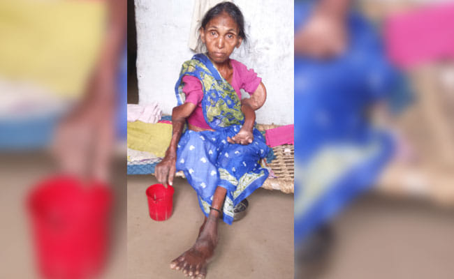 Jharkhand: 36 Dead In one decade because of Skeletal Fluorosis