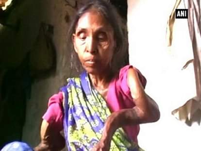 Village in grip of skeletal fluorosis 