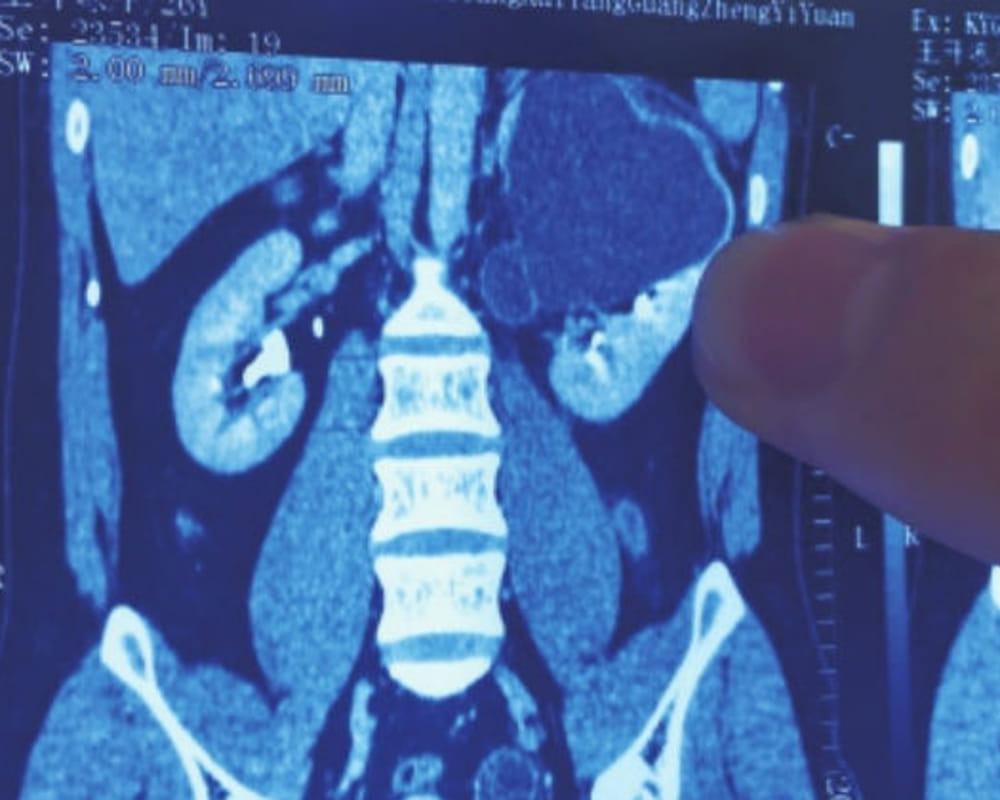 chinese man living with four kidney